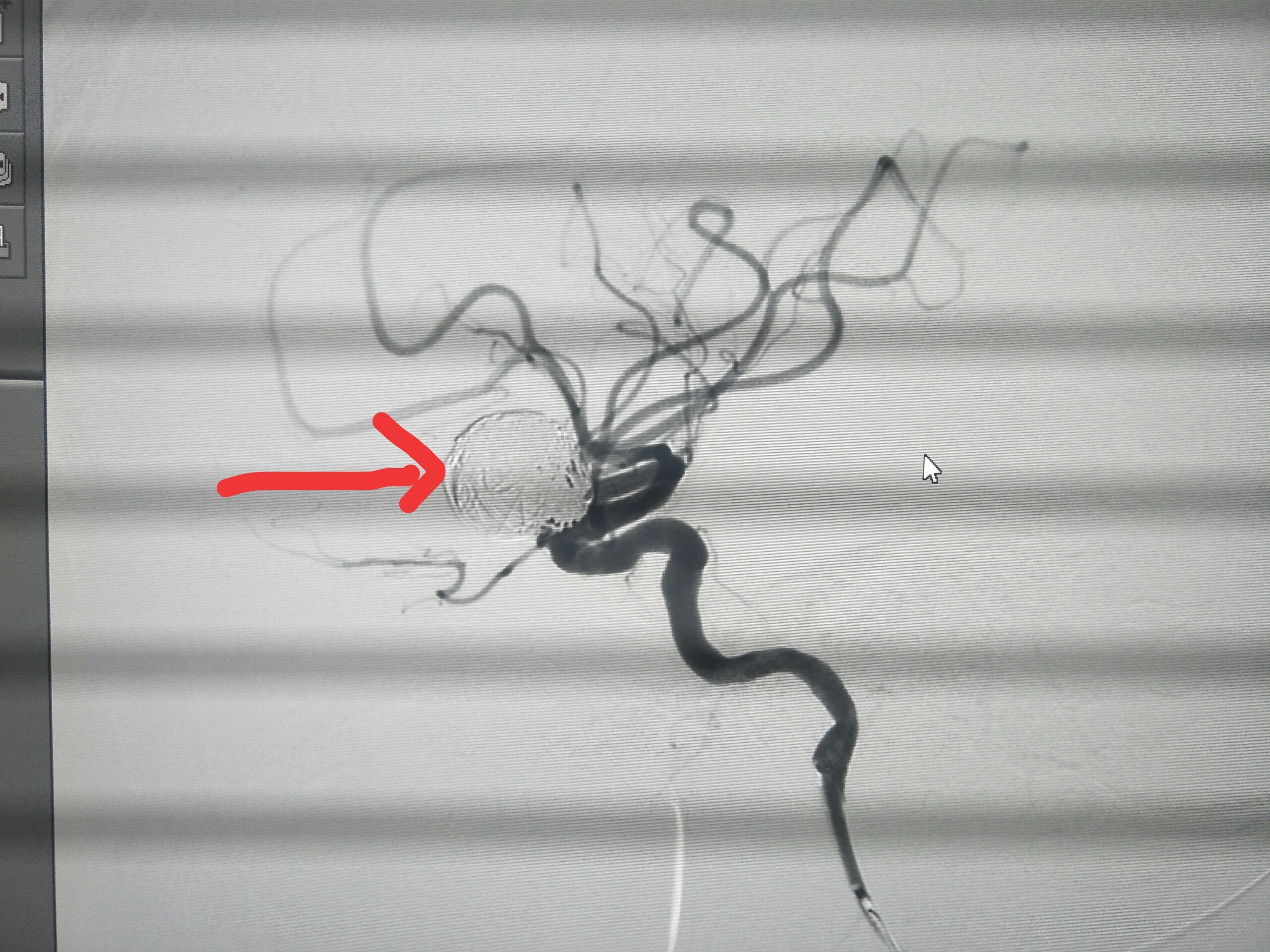 pipeline密网支架血流导向装置治疗大型动脉瘤