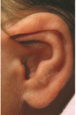 耳状面图片