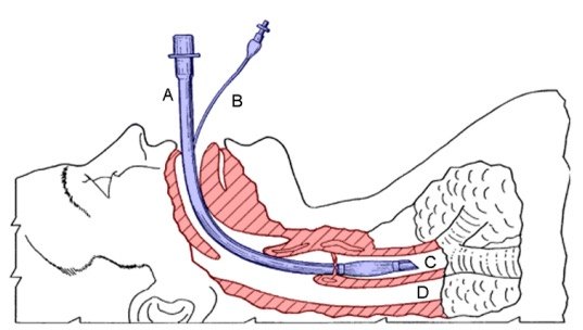 你对"气管插管"了解多少?
