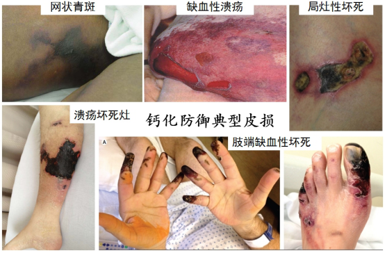 钙化防御尿毒症患者疼痛难忍致残的并发症