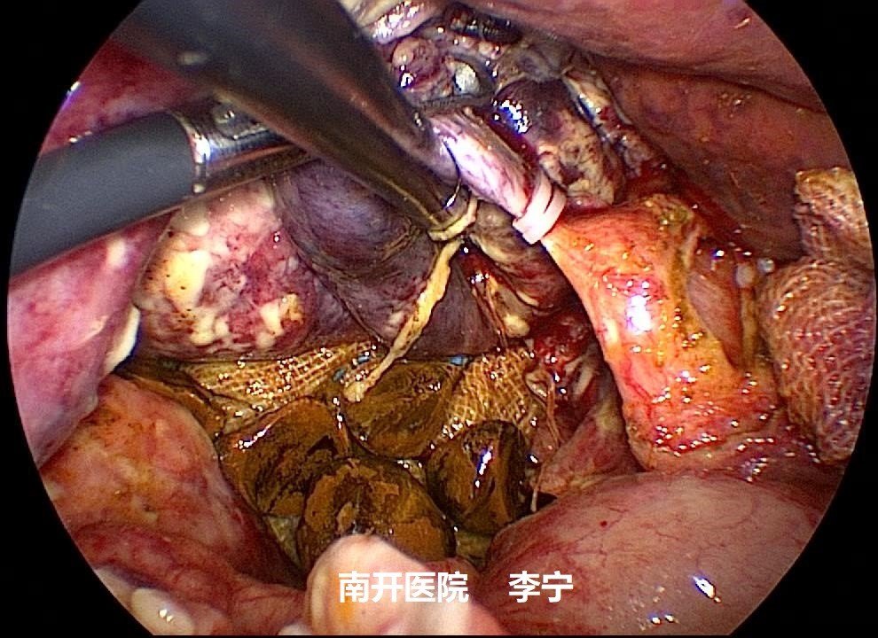 刘荣芝-23取出的胆总管结石-水印.jpg