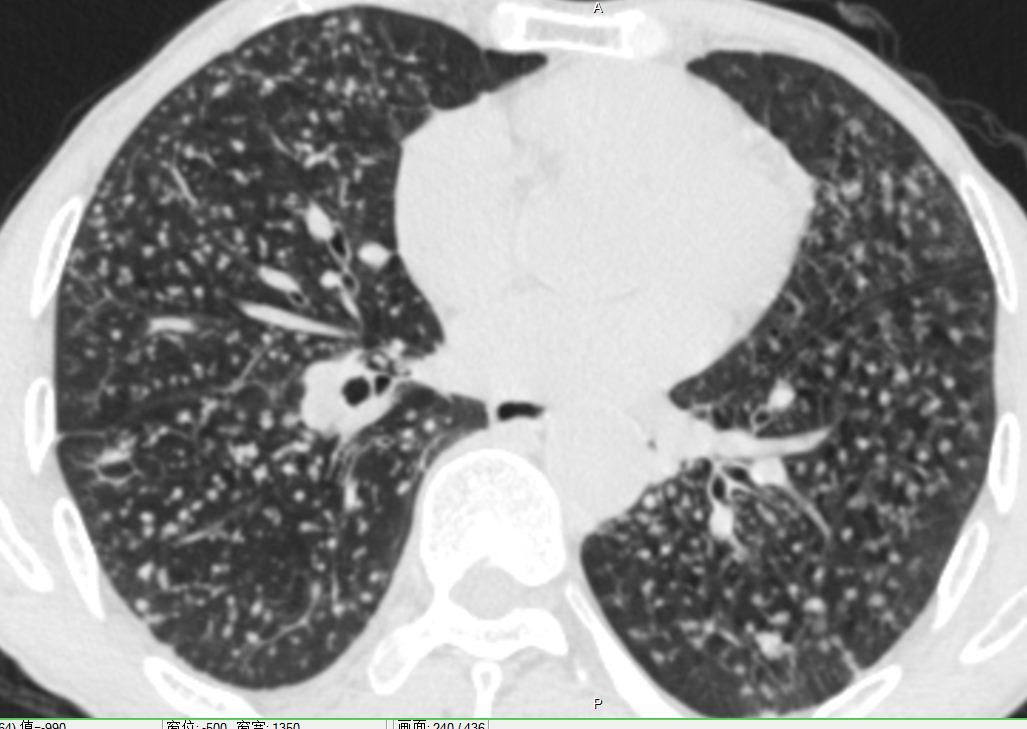 晚期尘肺病能做肺移植吗?