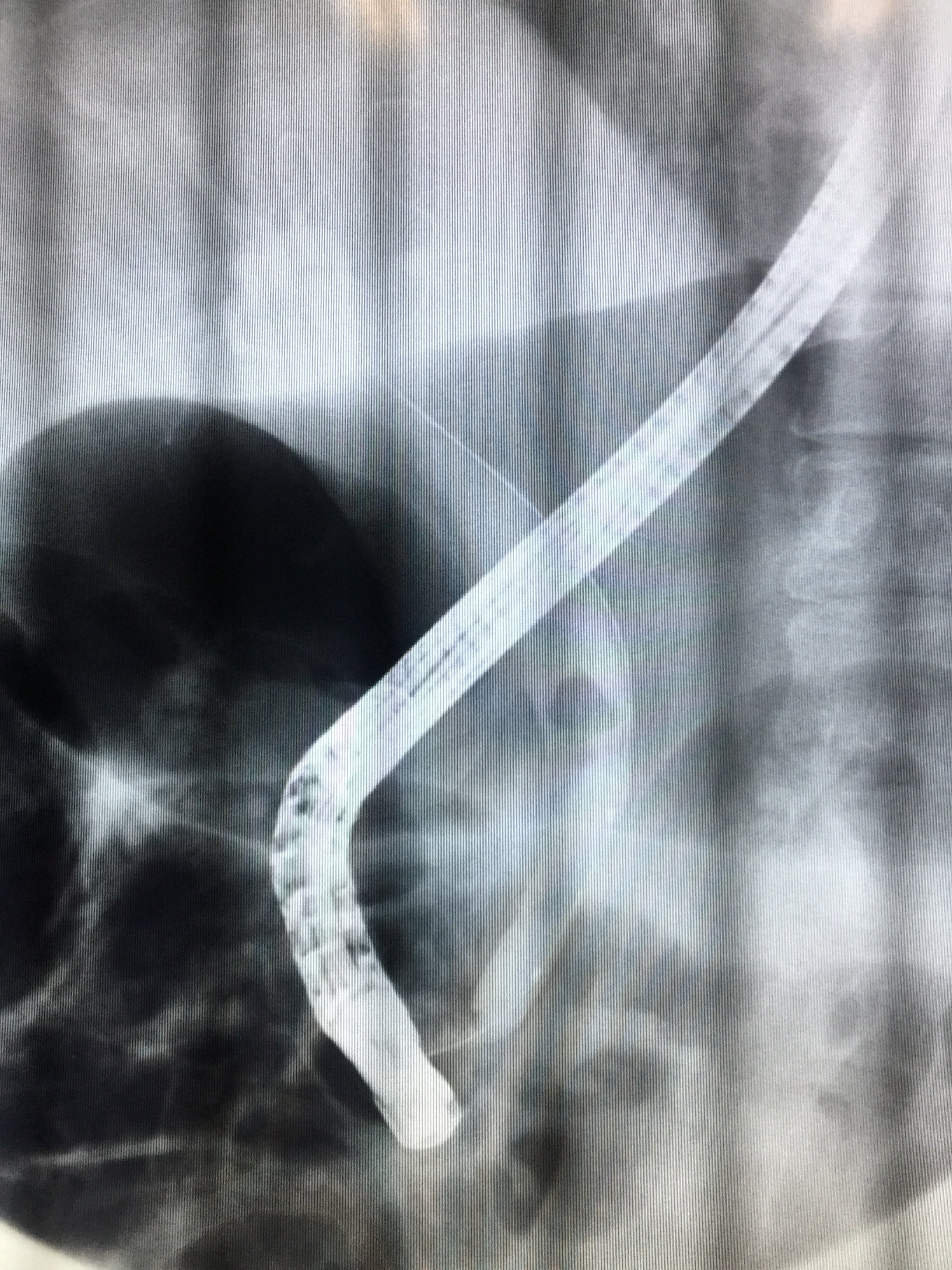ercp造影见胆总管结石