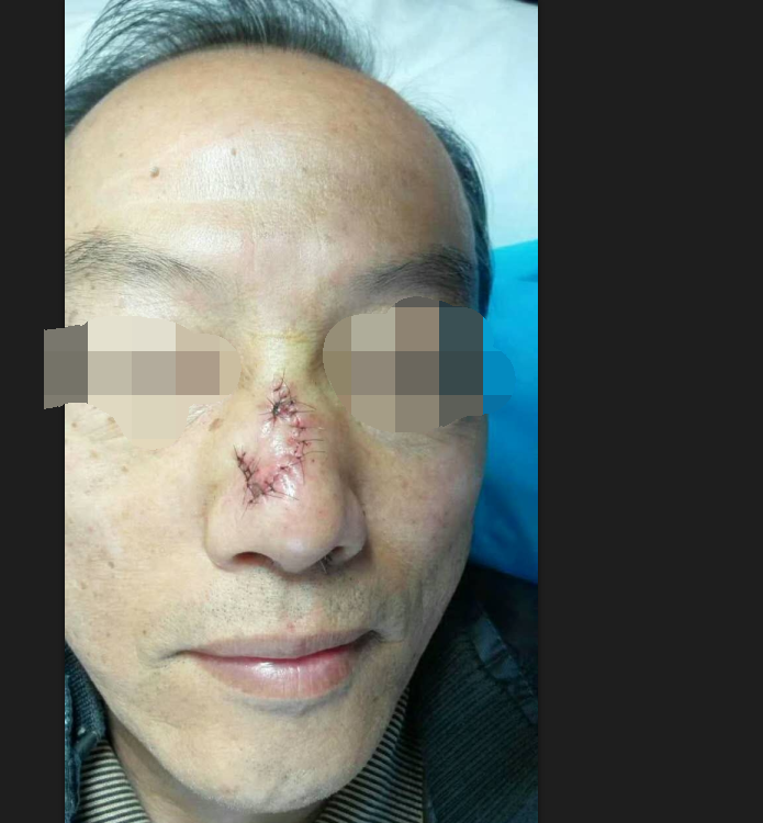 皮肤癌前病变-----日光性角化病的外科手术治疗