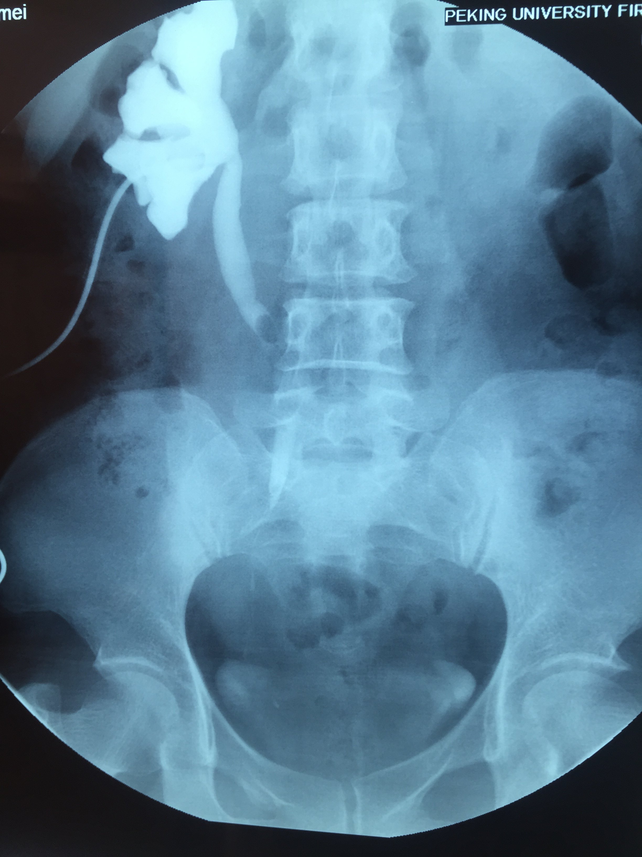 输尿管损伤术式之1开放膀胱输尿管成