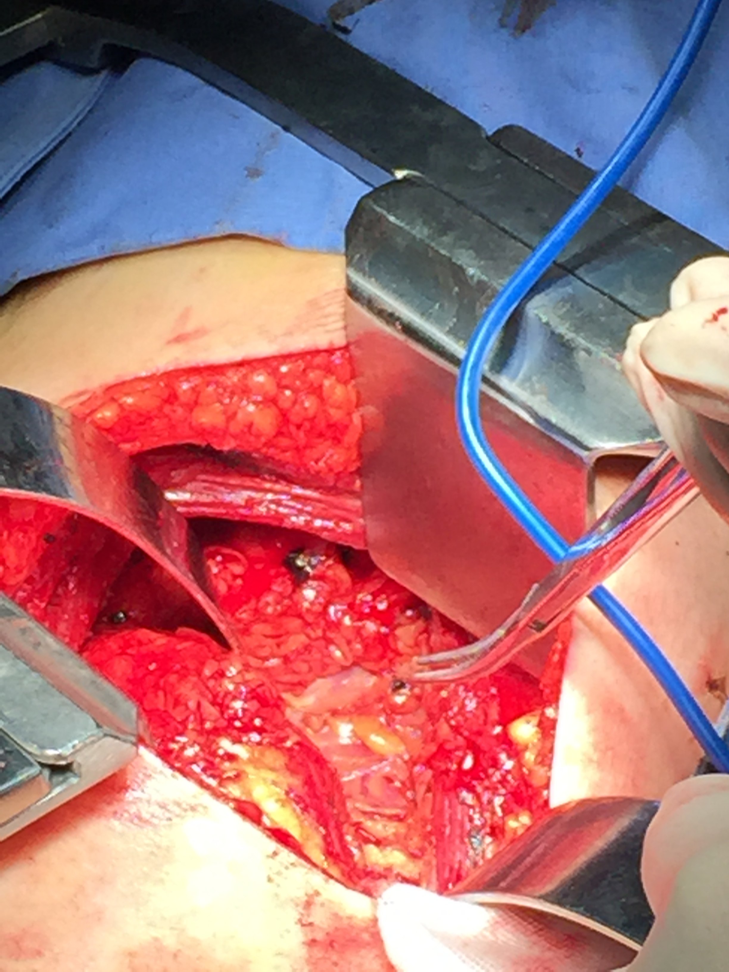 输尿管上段损伤修复3-----开放肾盂瓣成形术 - 好大夫在线