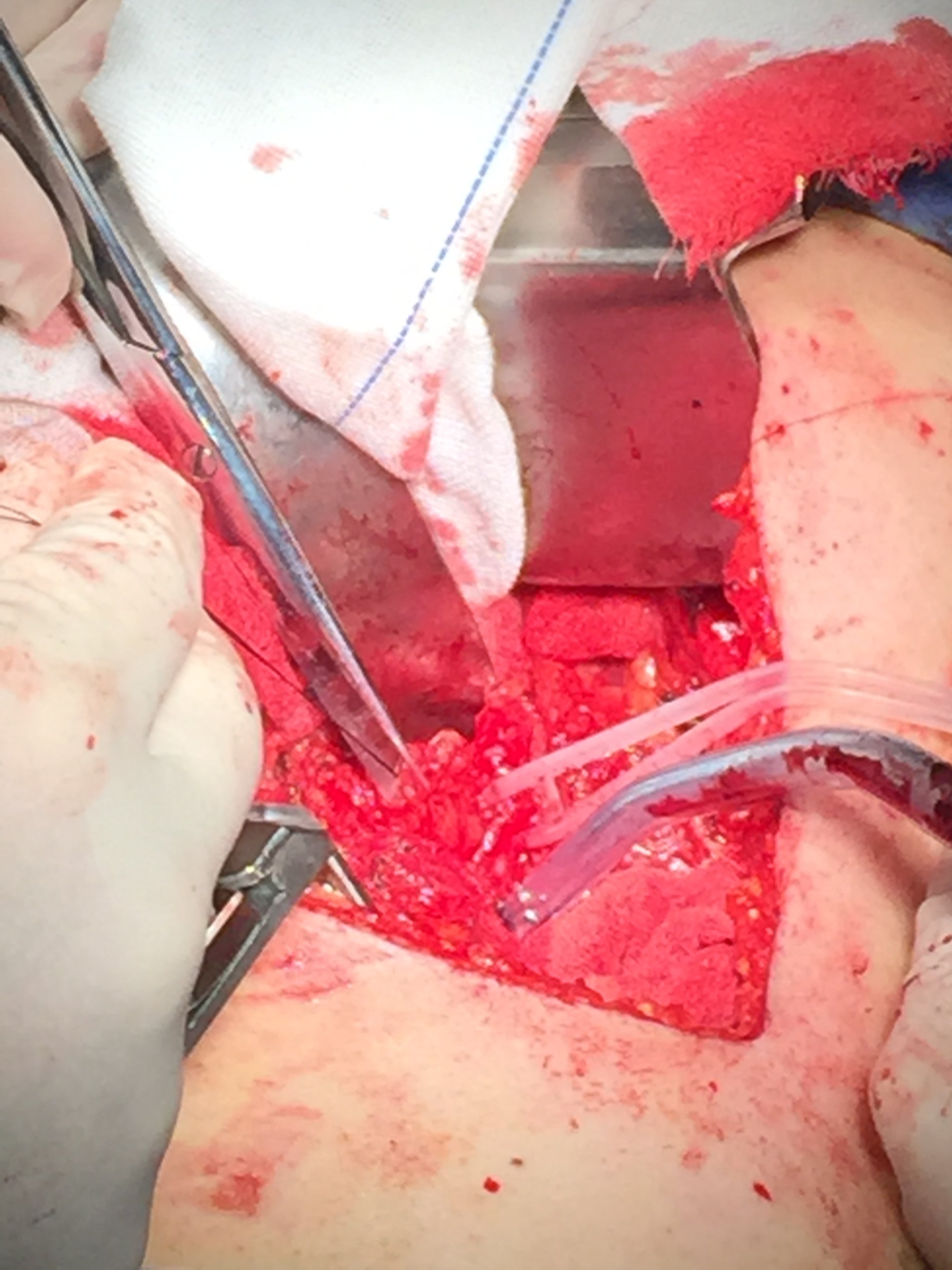 输尿管上段损伤修复3