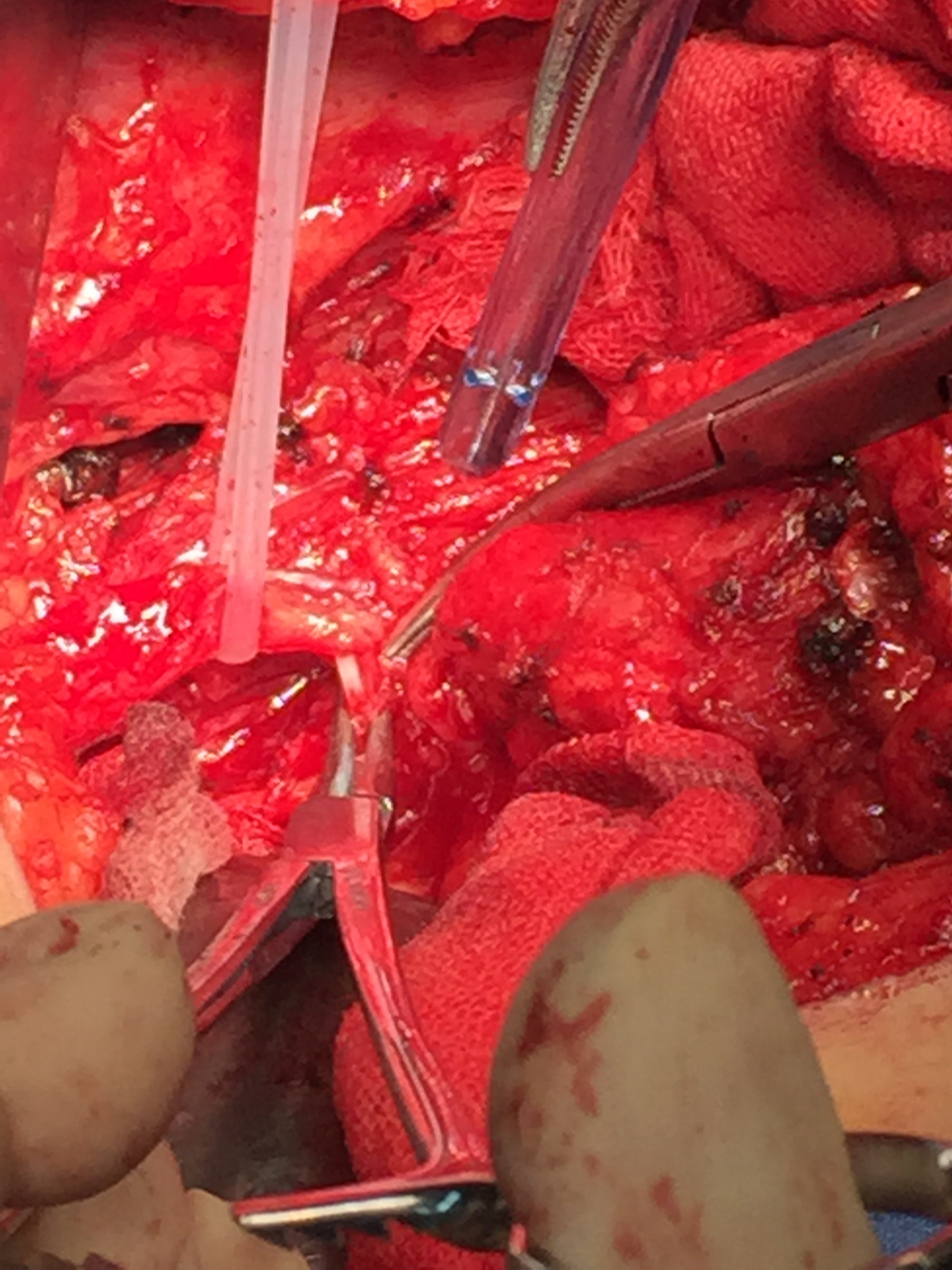 输尿管上段损伤修复3-----开放肾盂瓣成形术 - 好大夫在线