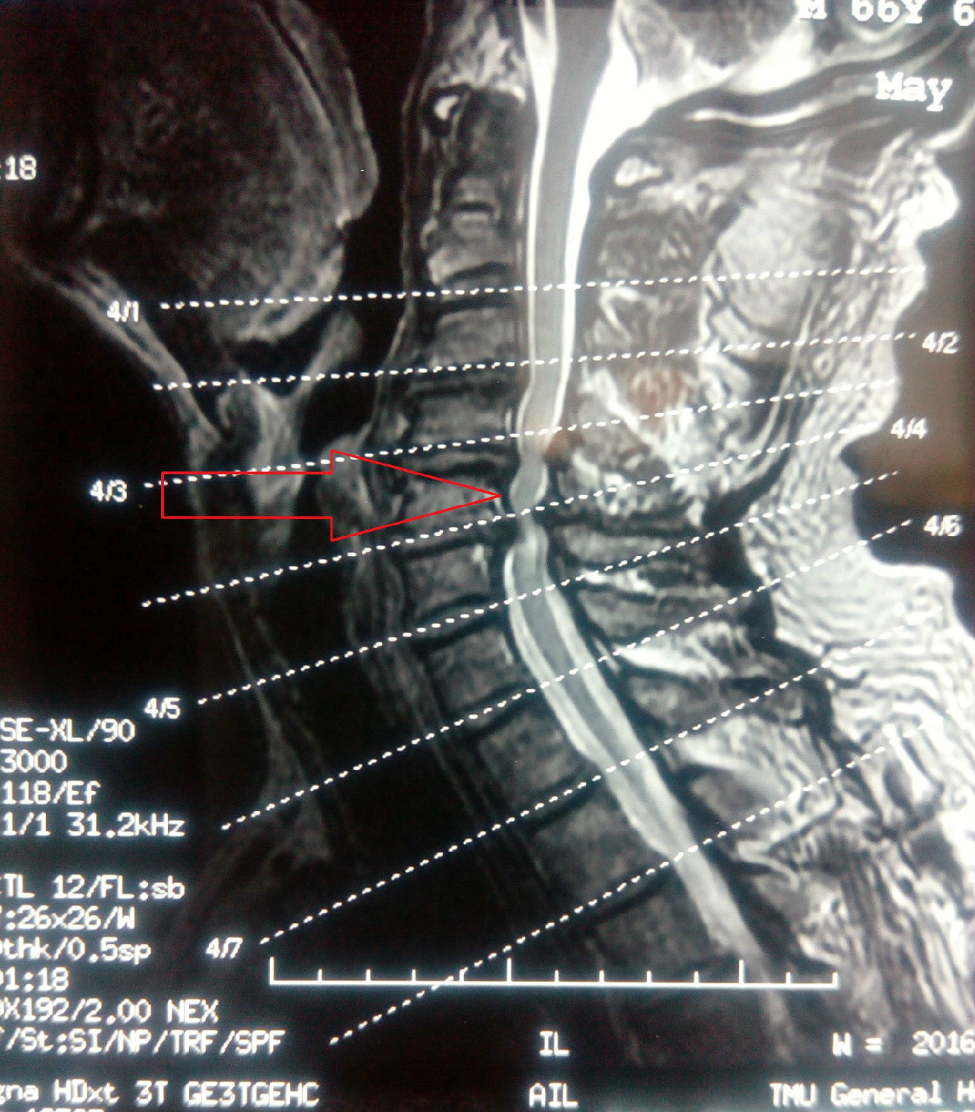 病例2-脊髓型颈椎病-后路椎管扩大成型术 - 好大夫在线