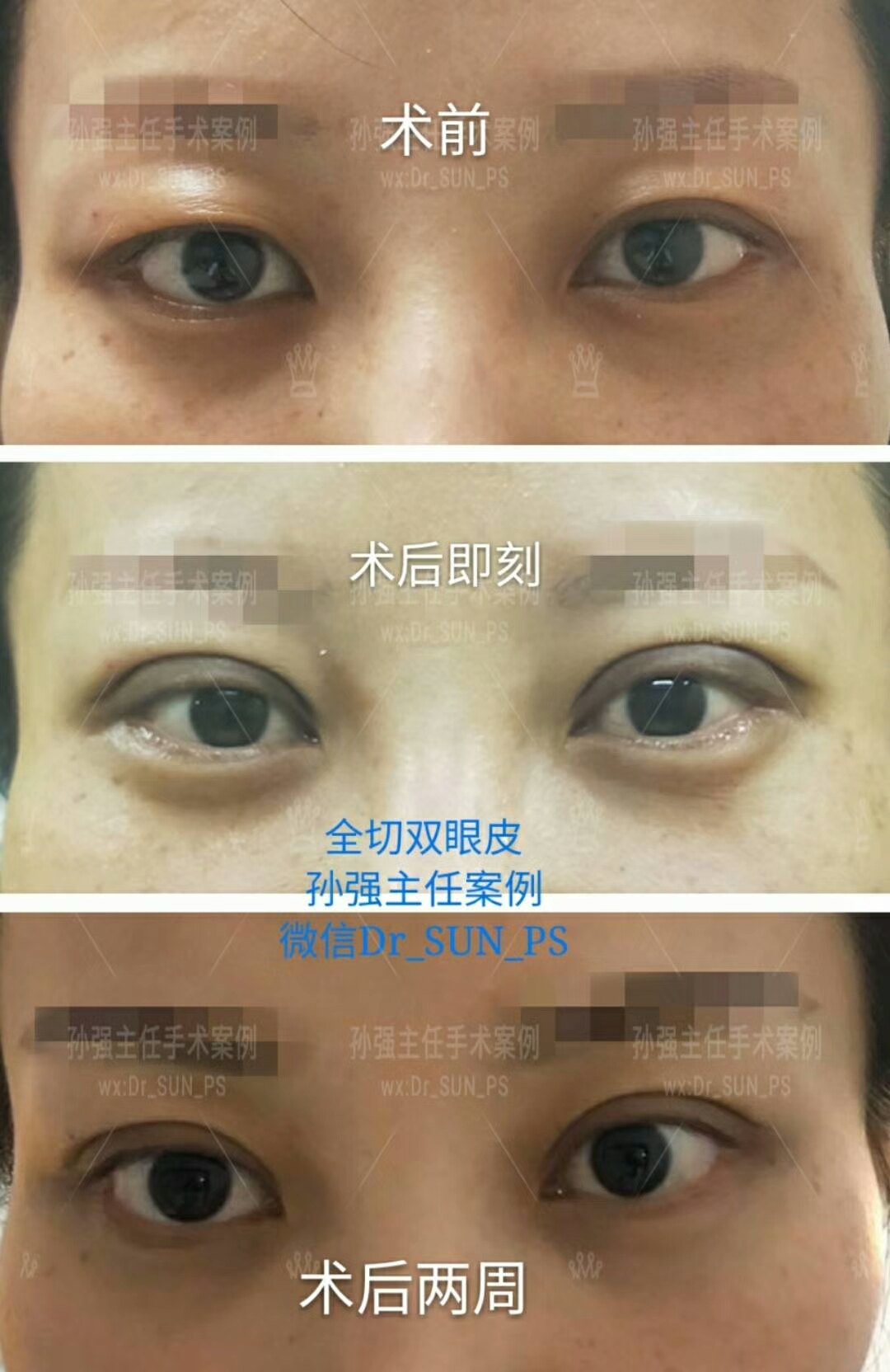 上海修复双眼皮的医生_双眼皮修复价格_大连双眼皮的修复