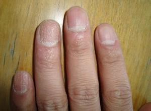 甲凹点健康教育 - 好大夫在线