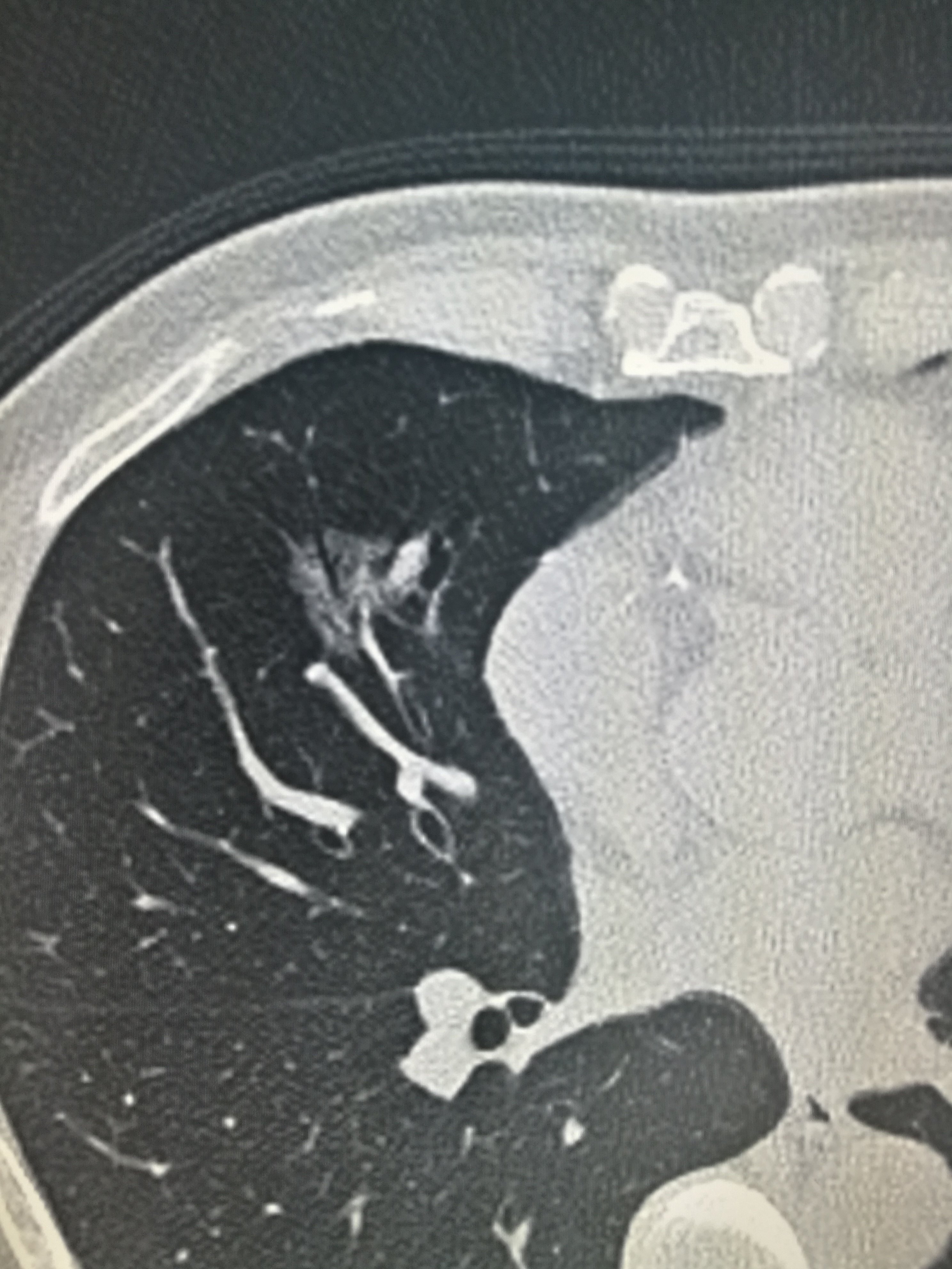 不规则磨玻璃密度结节