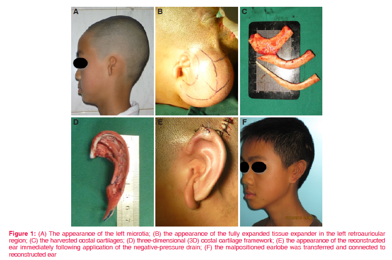 小耳畸形,通过扩张器扩张耳后皮肤进行耳再造上面是由王继华主任带领