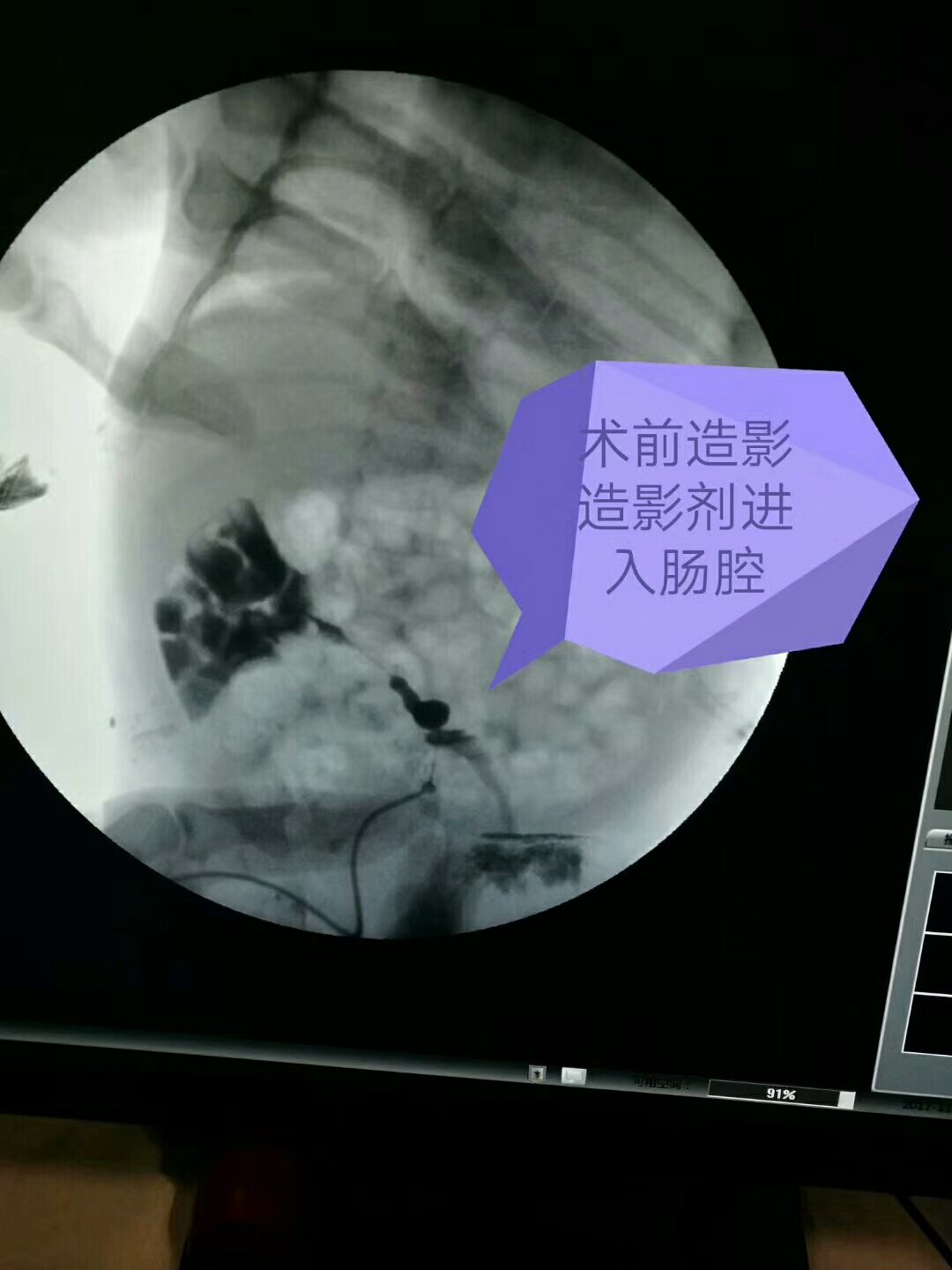 脐肠瘘 - 好大夫在线