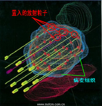 125碘粒子长什么样?什么叫粒子植入术? - 好大夫在线