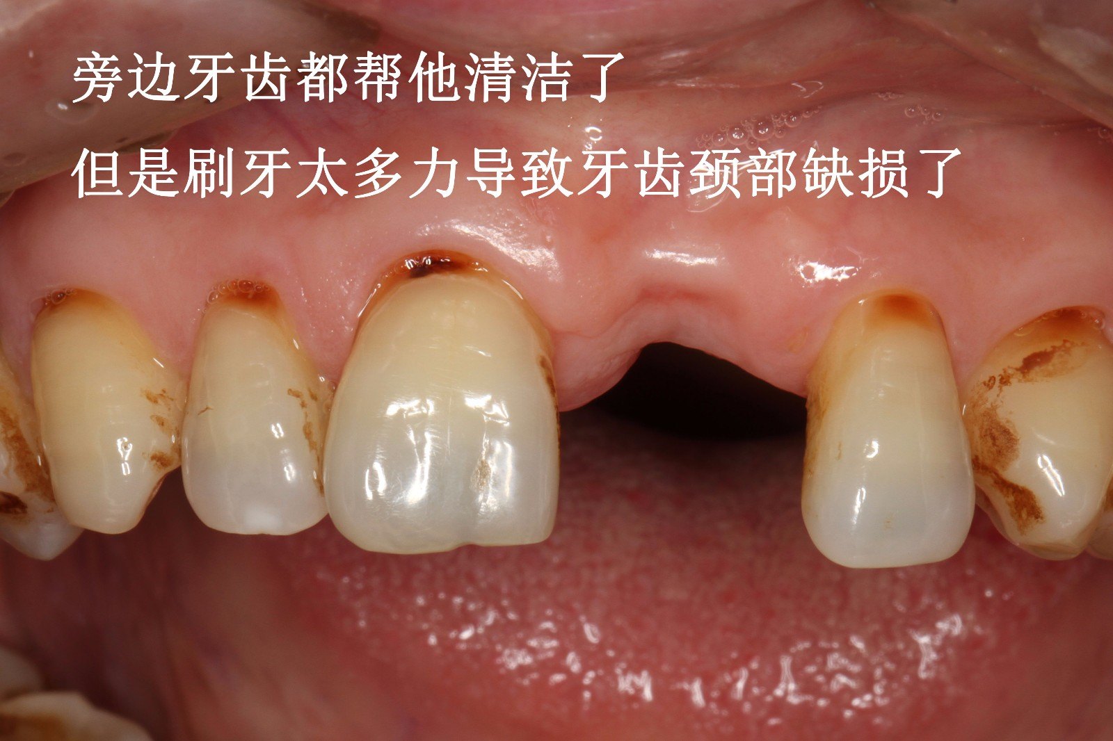 前牙全瓷固定桥修复 - 好大夫在线