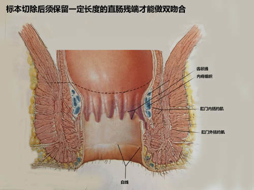 中国人发展完善的直肠癌保肛手术-保肛结肠拉