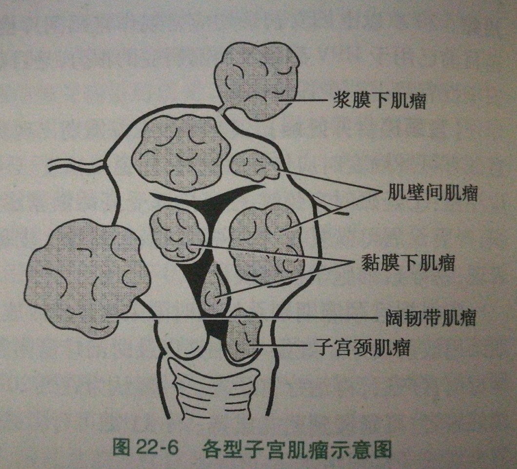 再來看看腹腔鏡下實際的圖片子宮前壁漿膜下肌瘤(剔除術前)子宮前壁