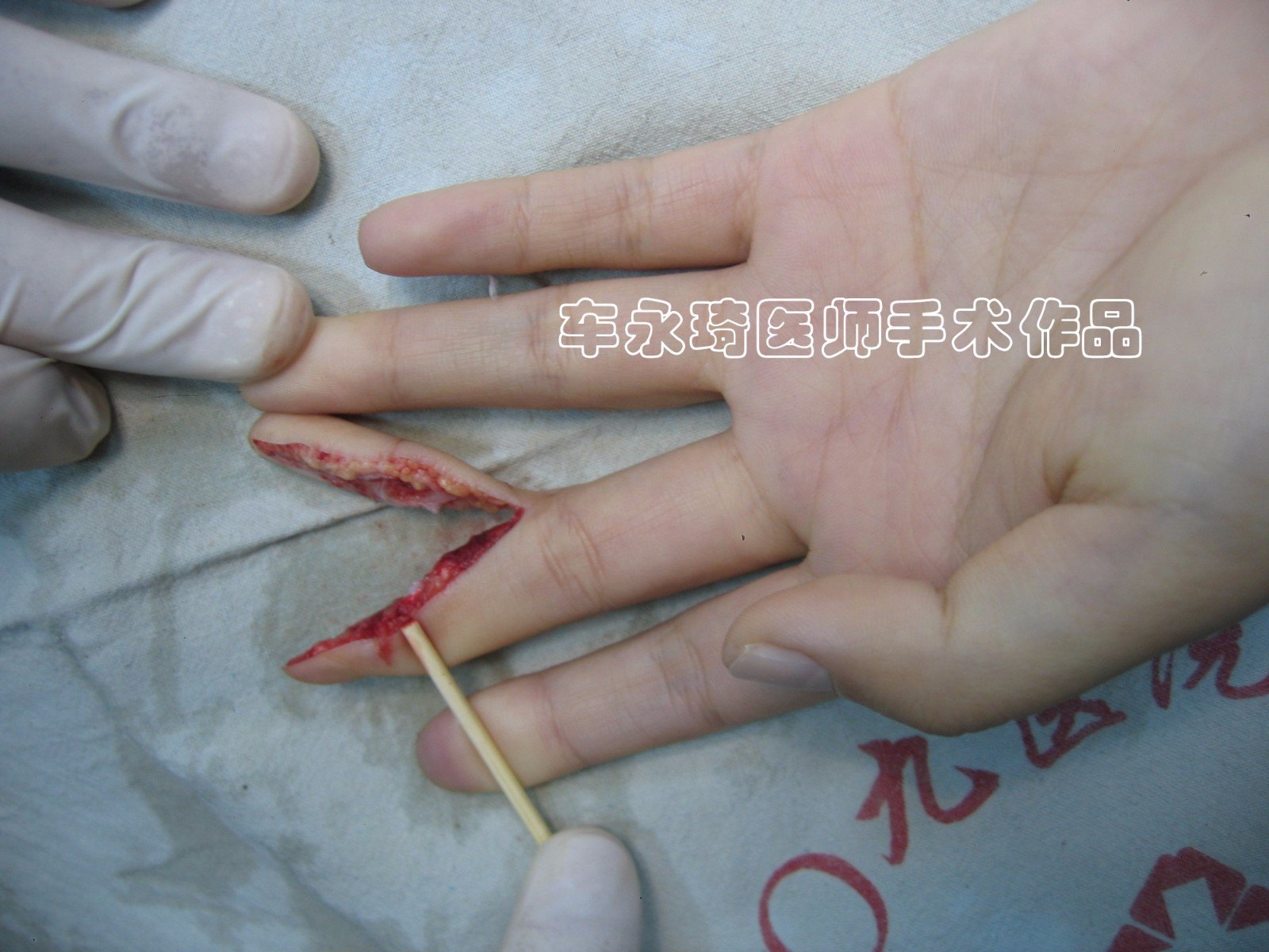 手指断了怎么办? - 好大夫在线