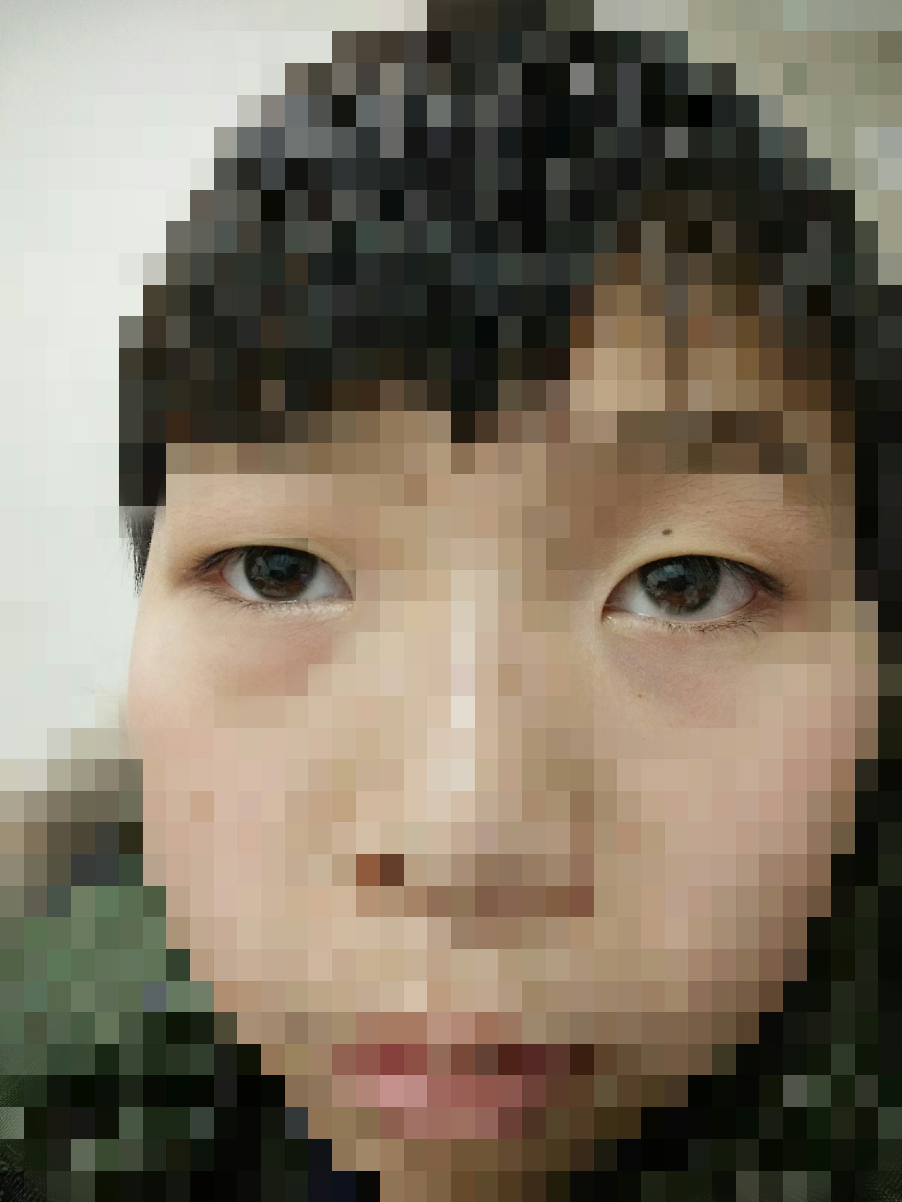 眼眶静脉性血管瘤. - 好大夫在线