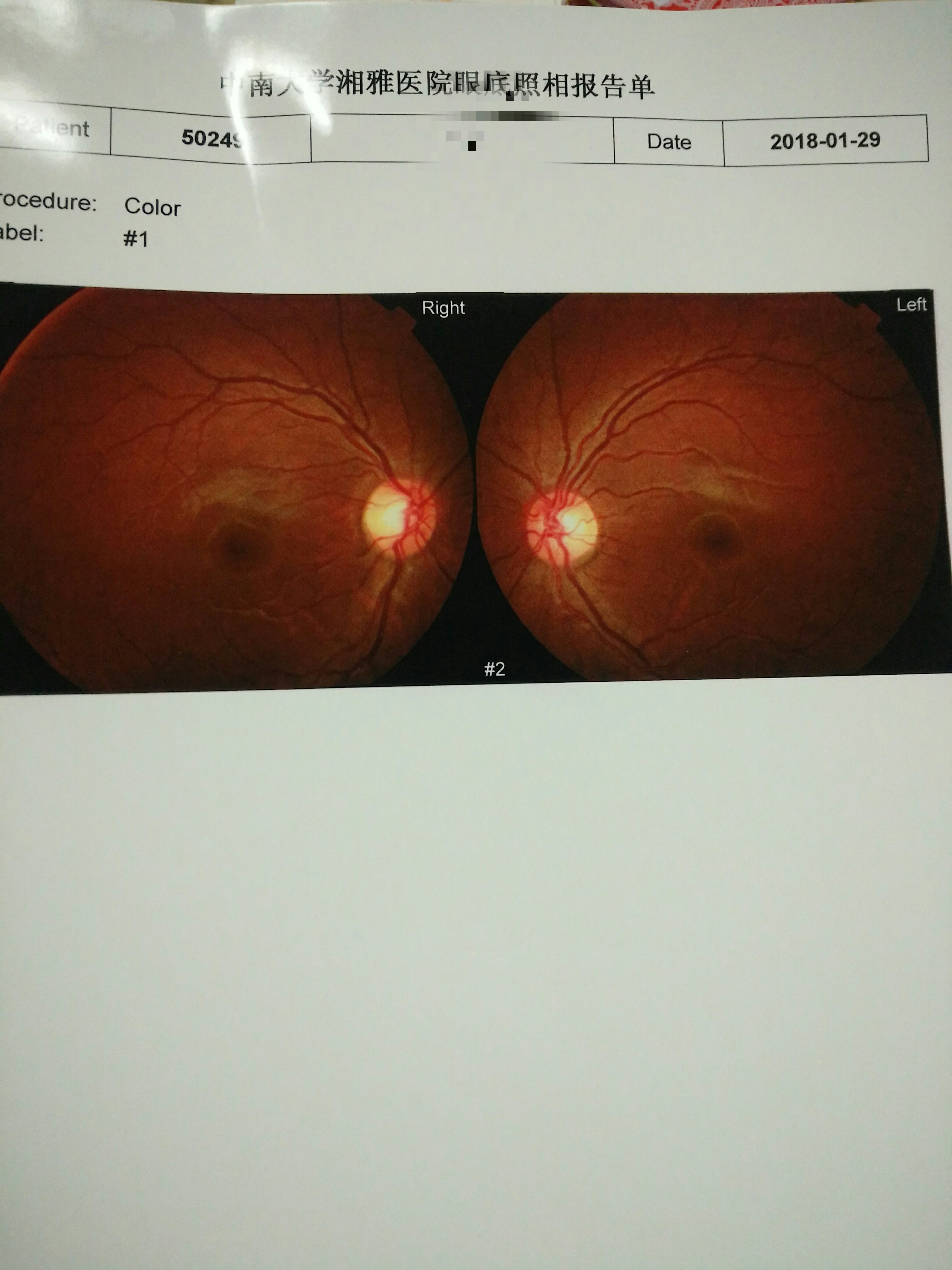 复查的左眼黄斑oct.复查的右眼黄斑oct患儿出院后一个星期复查的视力.