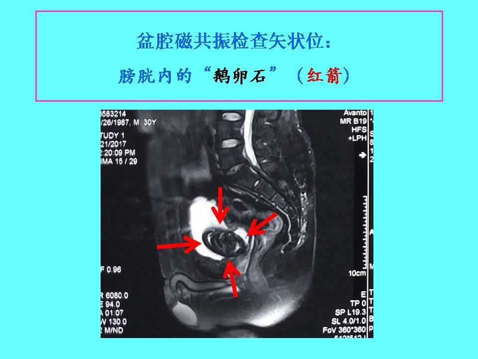 患者術前檢查時,做了一個盆腔核磁共振檢查,結果出人意料.