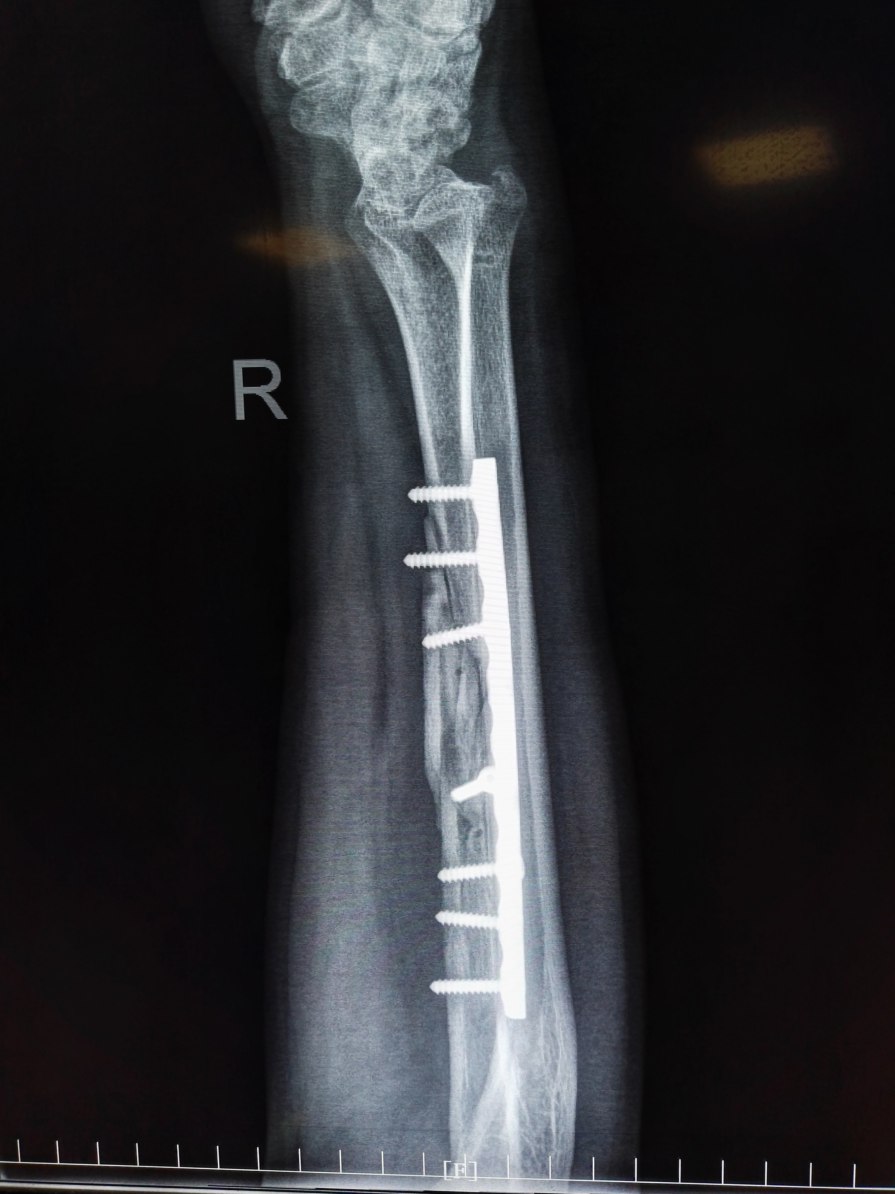 骨折骨痂图片一个月图片