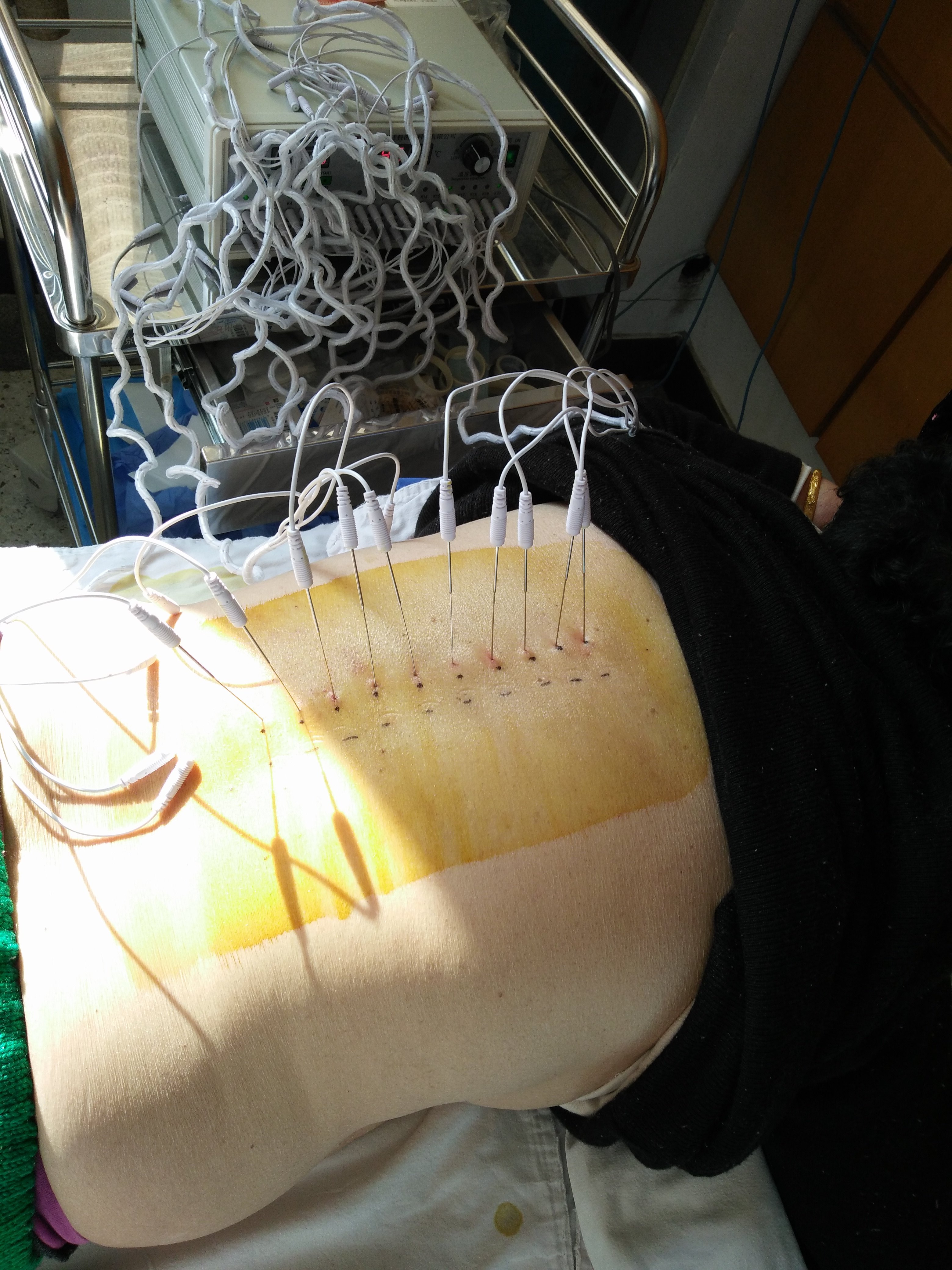 带状疱疹治疗病例 - 好大夫在线