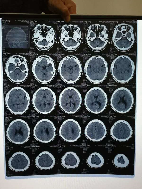 這位患友按照上述方法,給出了高質量的ct片子,為醫生提供了好的資料