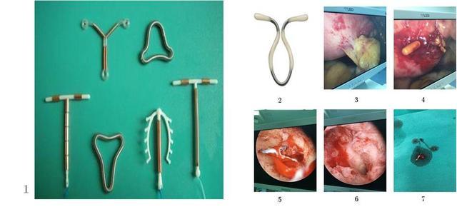 宫腔型节育环图片