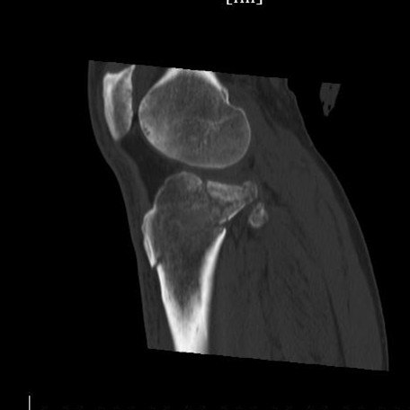 胫骨平台骨折术后骨性愈合