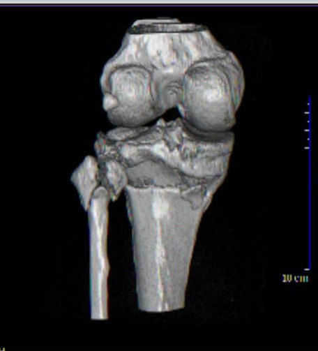胫骨平台骨折术后骨性愈合
