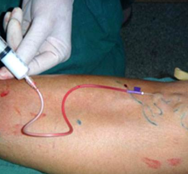 蚯蚓腿打针也能治愈了_静脉曲张_疾病介绍_介绍 - 好大夫在线