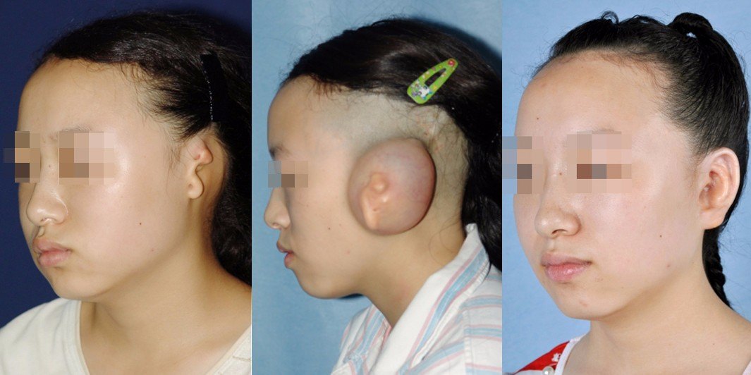 郭树忠教授:耳再造手术的得与失 - 好大夫在线