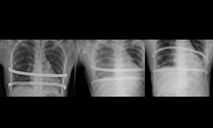 nuss手术批判之三:钢板的问题_漏斗胸微创矫正术_介绍_治疗介绍 - 好