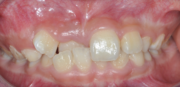恒牙期(12岁以后) 多数牙齿畸形是真性这个时期,孩子的颌骨,牙齿发育