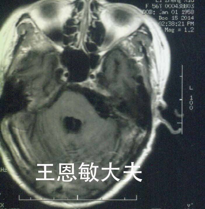复发听神经瘤的射波刀治疗--每周一例