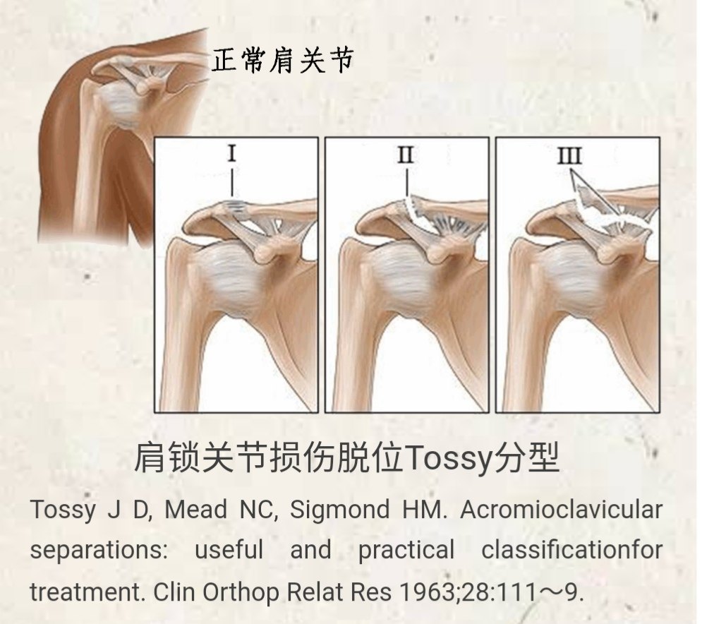 肩锁关节脱位Ⅲ型,喙锁韧带重建手术 
