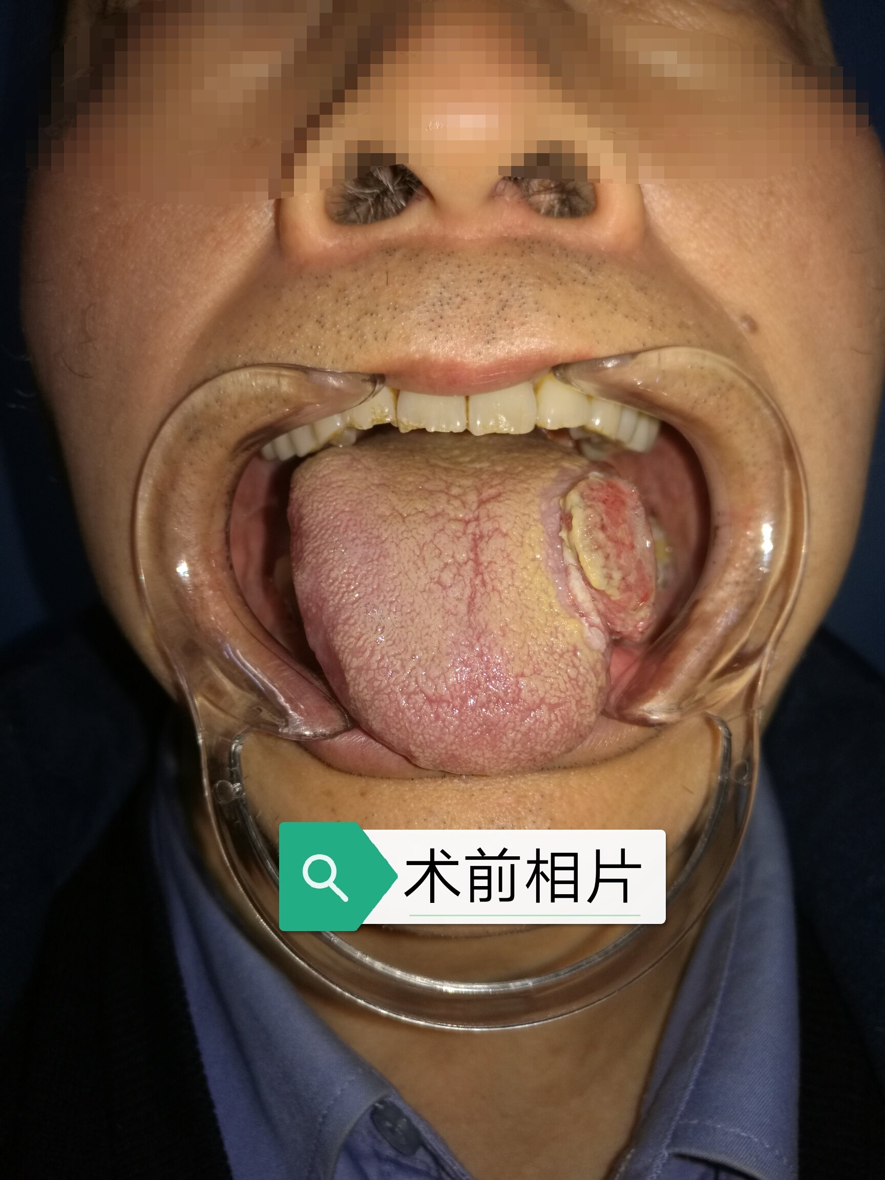 舌癌的图片大全晚期图片