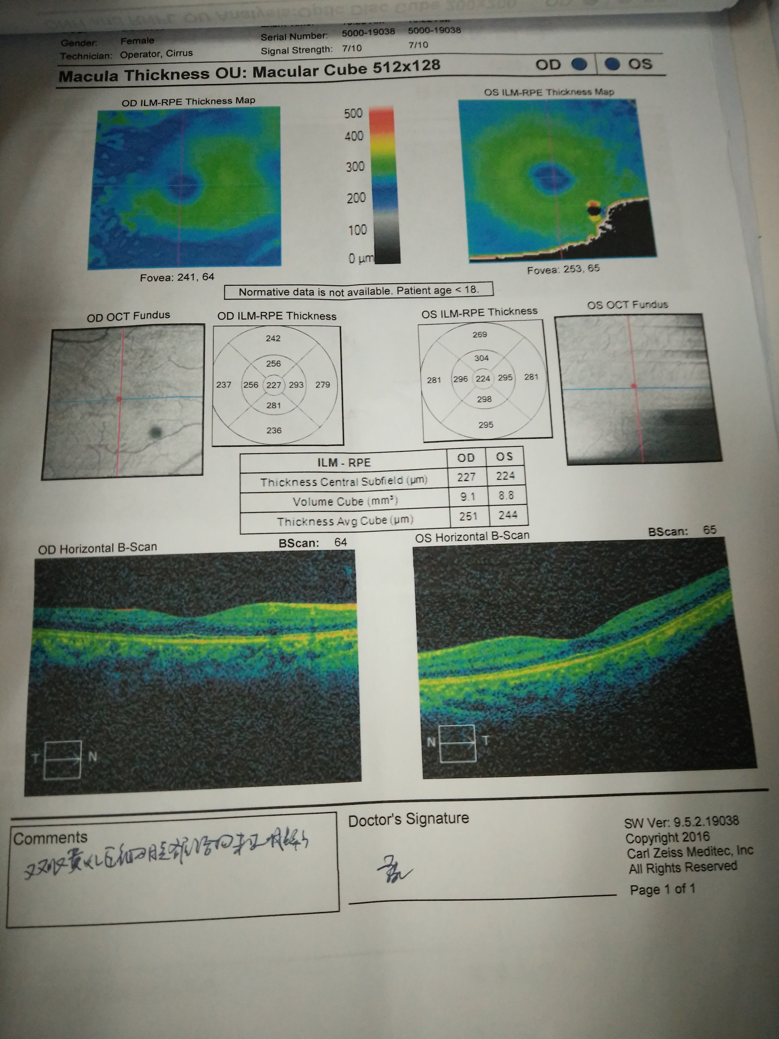 《一》定义:axenfeld-rieger综合征是指双眼发育缺陷,伴或不伴有全身