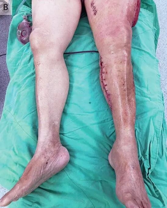 下肢静脉血栓的罕见并发症-股蓝肿 病例报告