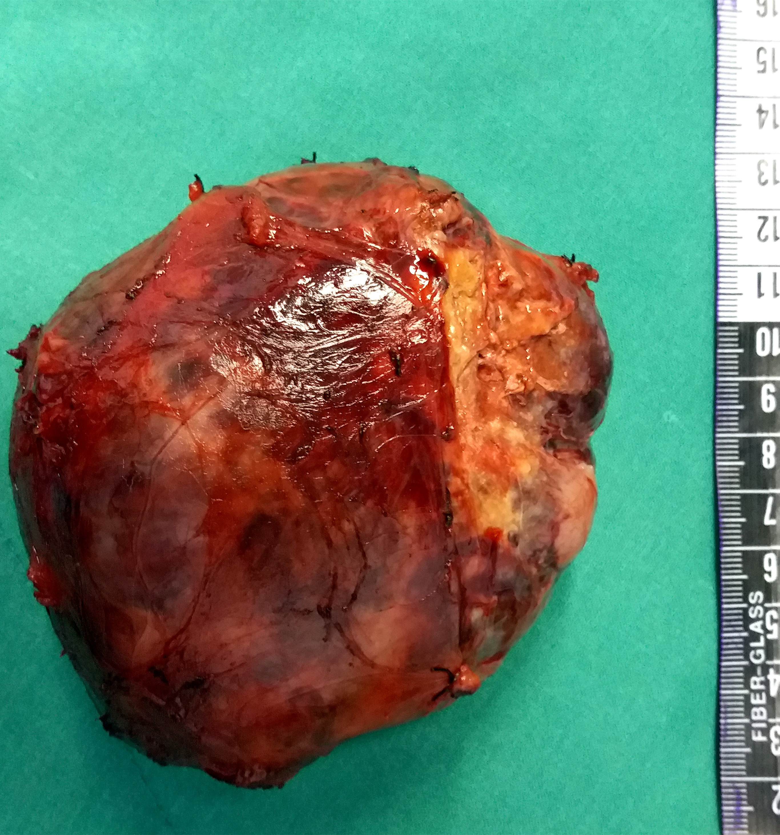 那些我救治过的病人——用最小创伤切除巨大胰腺肿瘤! - 好大夫在线