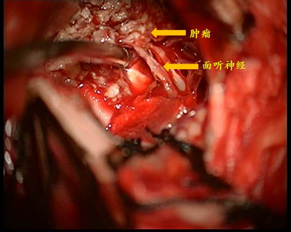 我的手术病例回顾(二):大型听神经瘤显微切除 - 好大夫在线