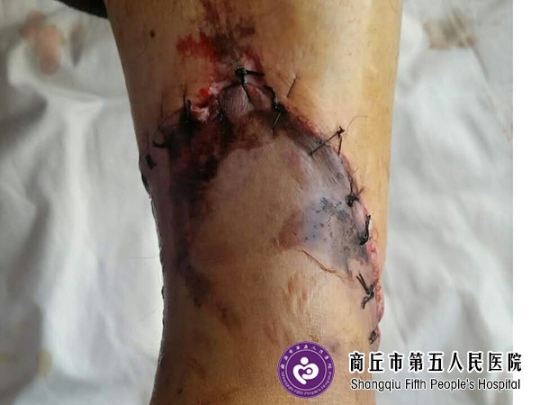 手术后伤口红肿化脓,该怎么办?