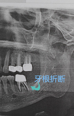 为什么做了牙套后还是出现牙根折断? - 好大夫在线