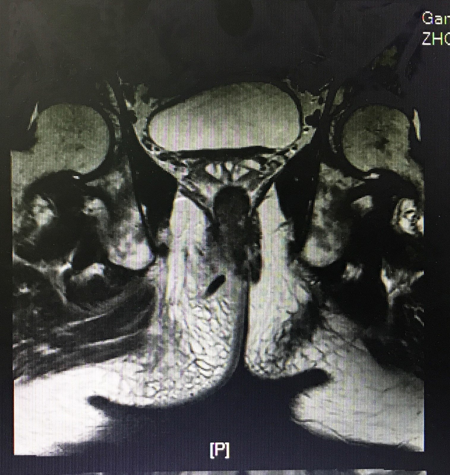 棗說愛你不容易1棗核致肛周膿腫1例