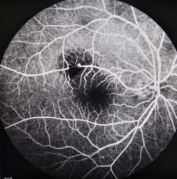 眼底出血之视网膜大动脉瘤