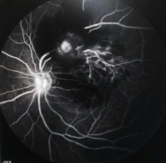 眼底出血之视网膜大动脉瘤