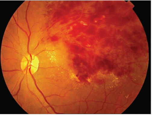 眼底出血之视网膜静脉闭塞 - 好大夫在线