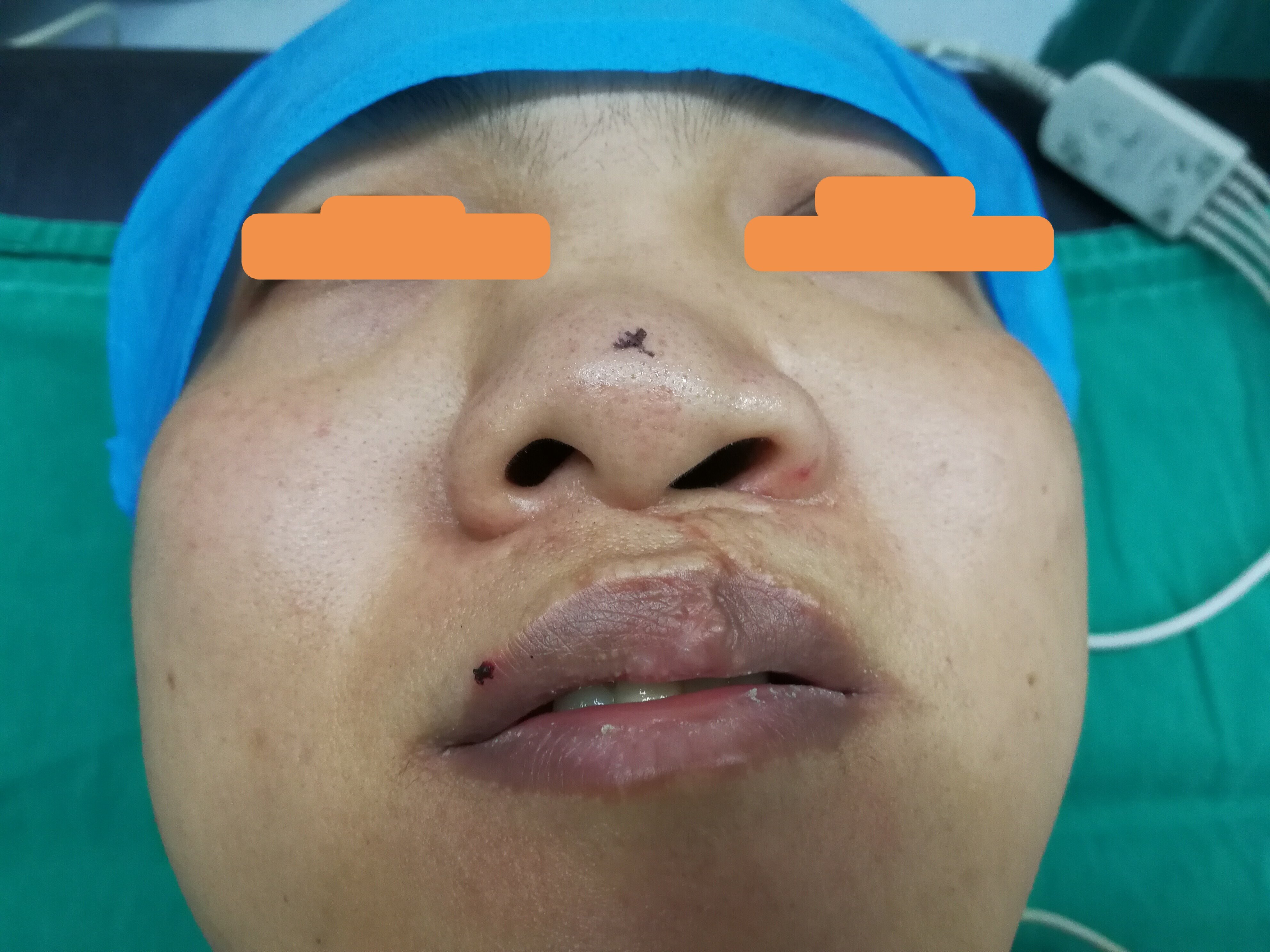 鼻中隔手术后塌陷图图片